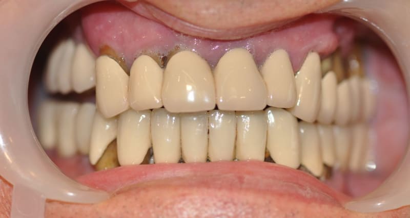 Before dental treatment - Patient case 1 showing initial condition