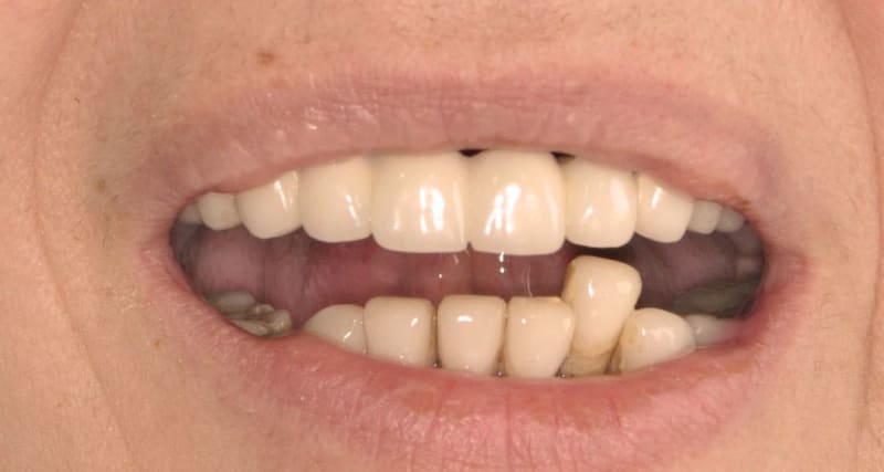 Before dental treatment - Patient case 2 showing initial condition