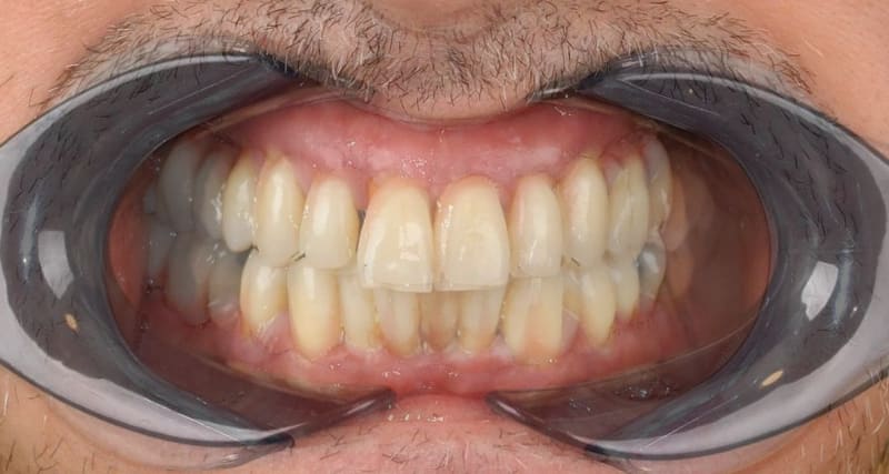 Before dental implant - Patient case 1 showing initial condition