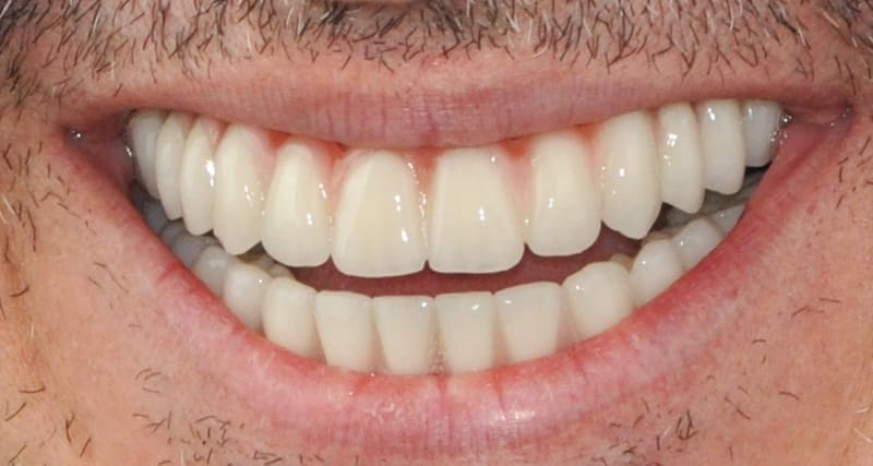 After dental implant - Patient case 1 showing successful treatment results