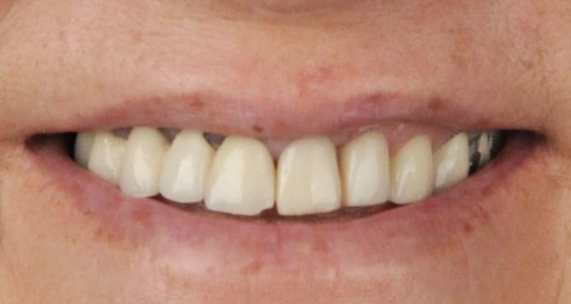 Before dental implant - Patient case 2 showing initial condition