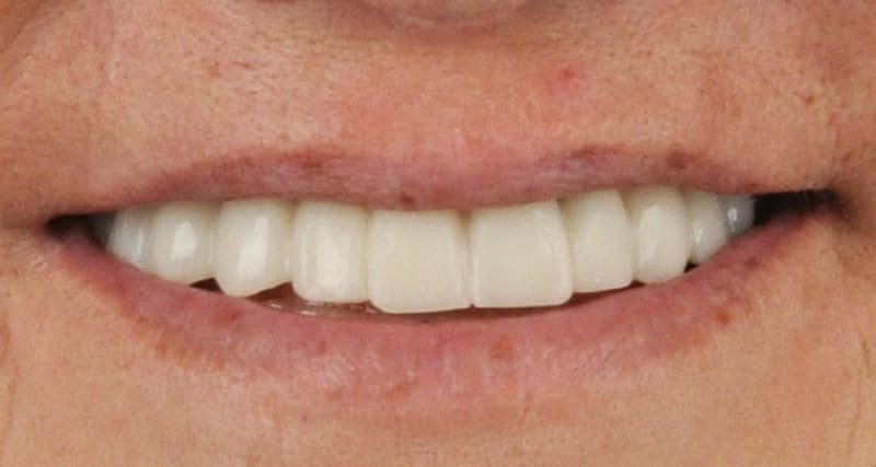 After dental implant - Patient case 2 showing successful treatment results