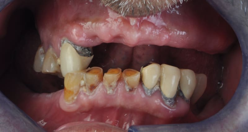 Before dental implant - Patient case 3 showing initial condition