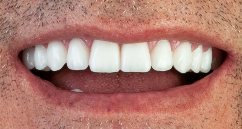After dental implant - Patient case 3 showing successful treatment results