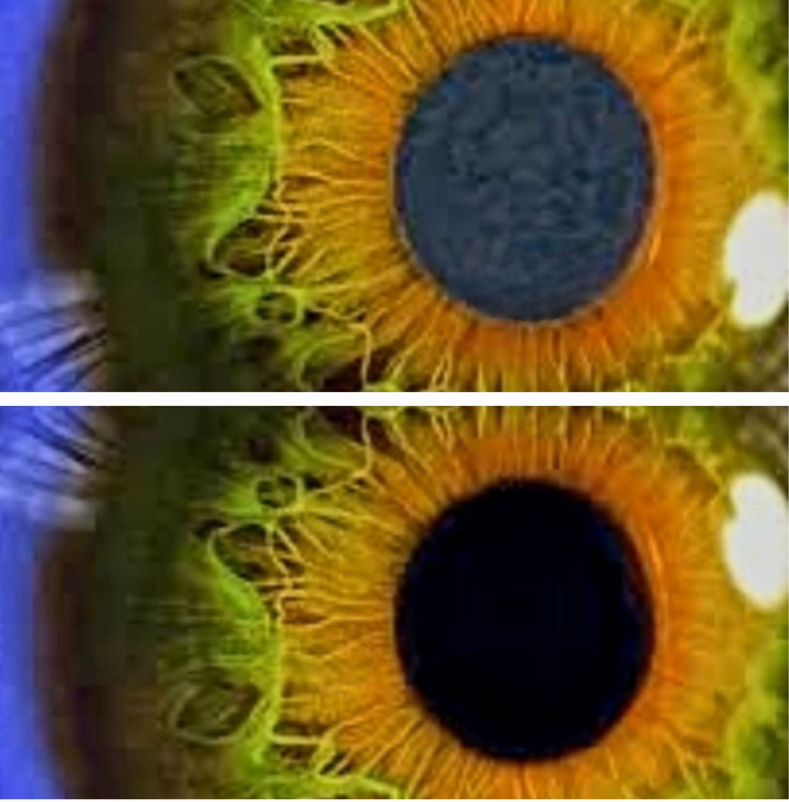 Capsulotomia YAG laser per cataratta secondaria