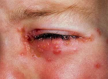 Cheratite da herpes simplex