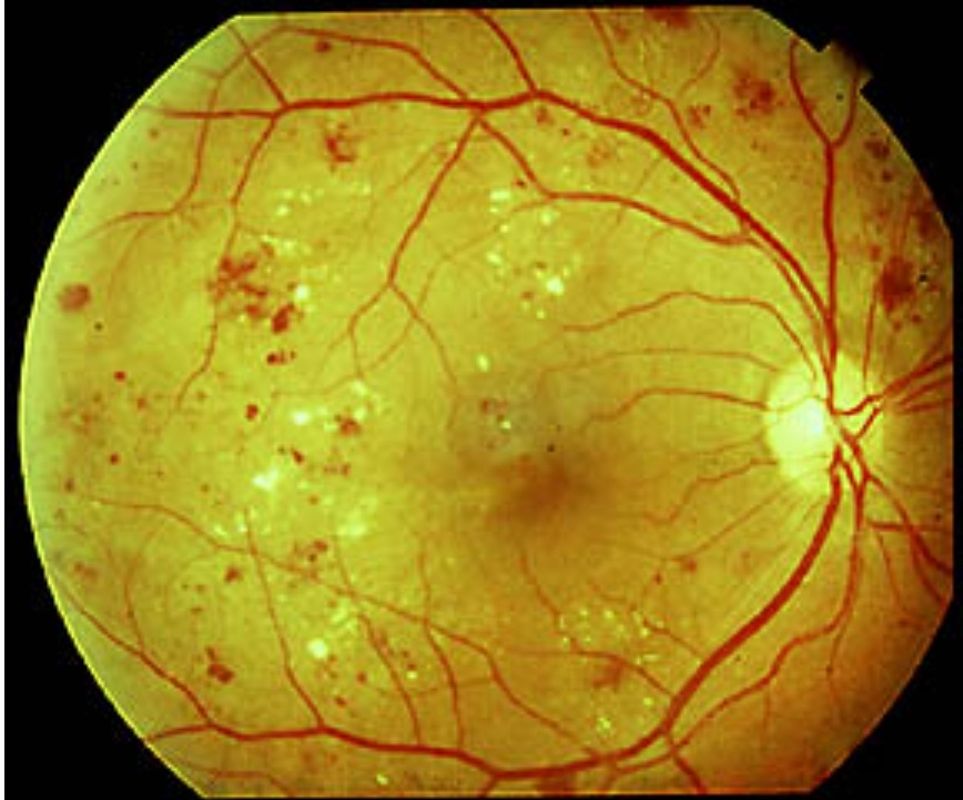 Retinopatia Diabetica