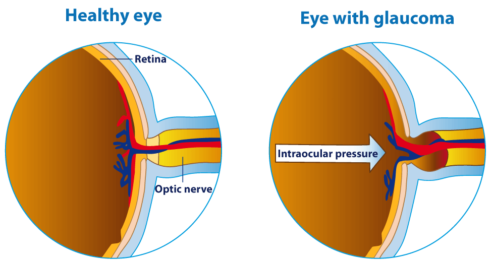 Glaucoma