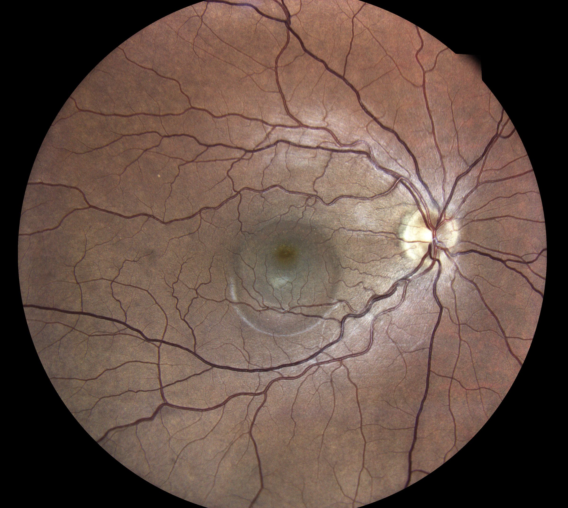 corioretinopatia sierosa centrale