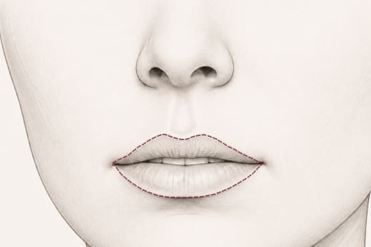 Narbenverlauf: Die Narbe liegt auf dem Lippenrand.