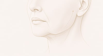 Feine Knitterlinien, Skinbooster bei UNIKAT AESTHETIK Stuttgart