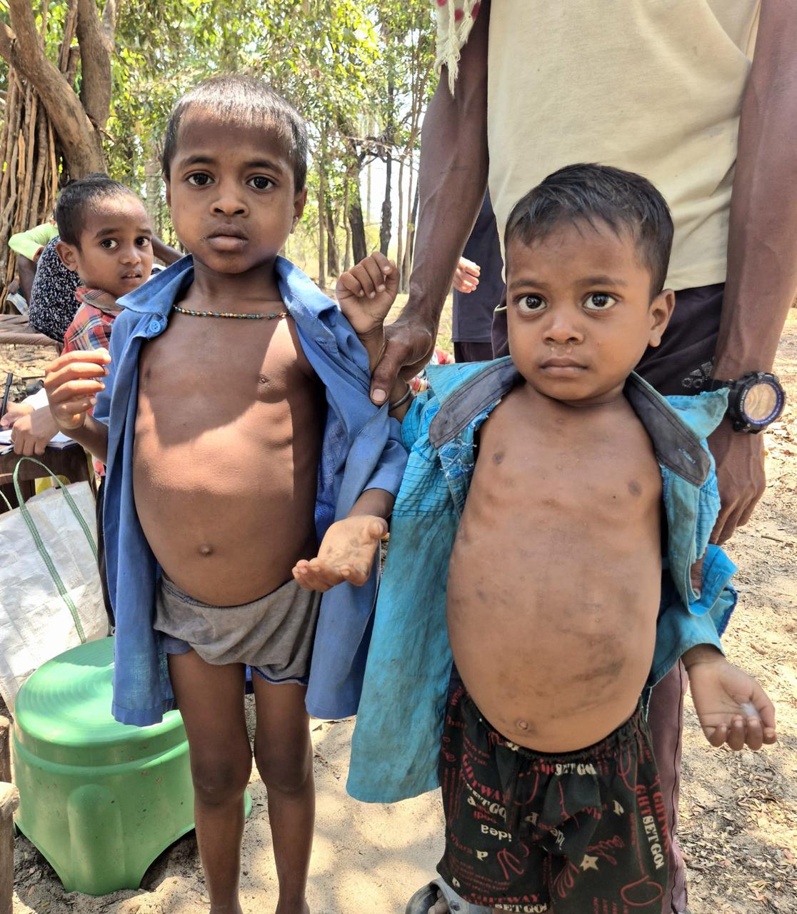 2-3 ग्राम हीमोग्लोबिन से 9 ग्राम तक पहुंची बच्चियों की सेहत, डॉक्टरों की मेहनत रंग लाई