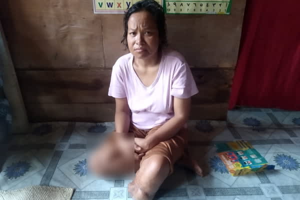 Khatijah Penderita Tumor Tulang, Pasrah Merintih Kesakitan