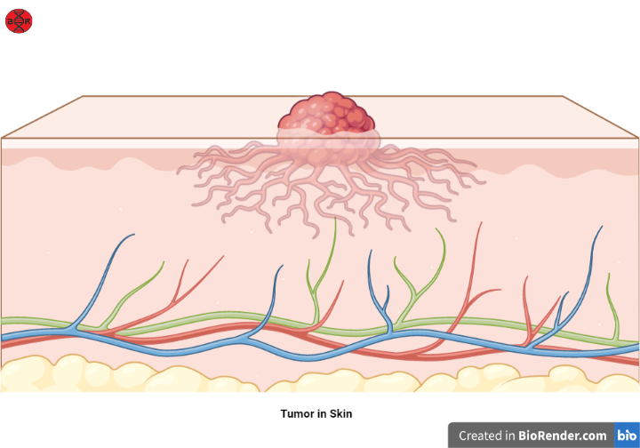 Tumor cells