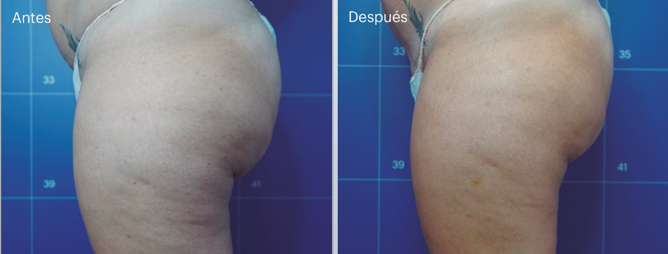 Diminution du relâchement et amélioration de la cellulite
