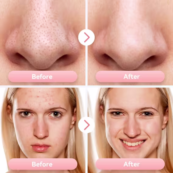 FREESHOW Siyah Nokta Temizleyici Gözenek Vakumu