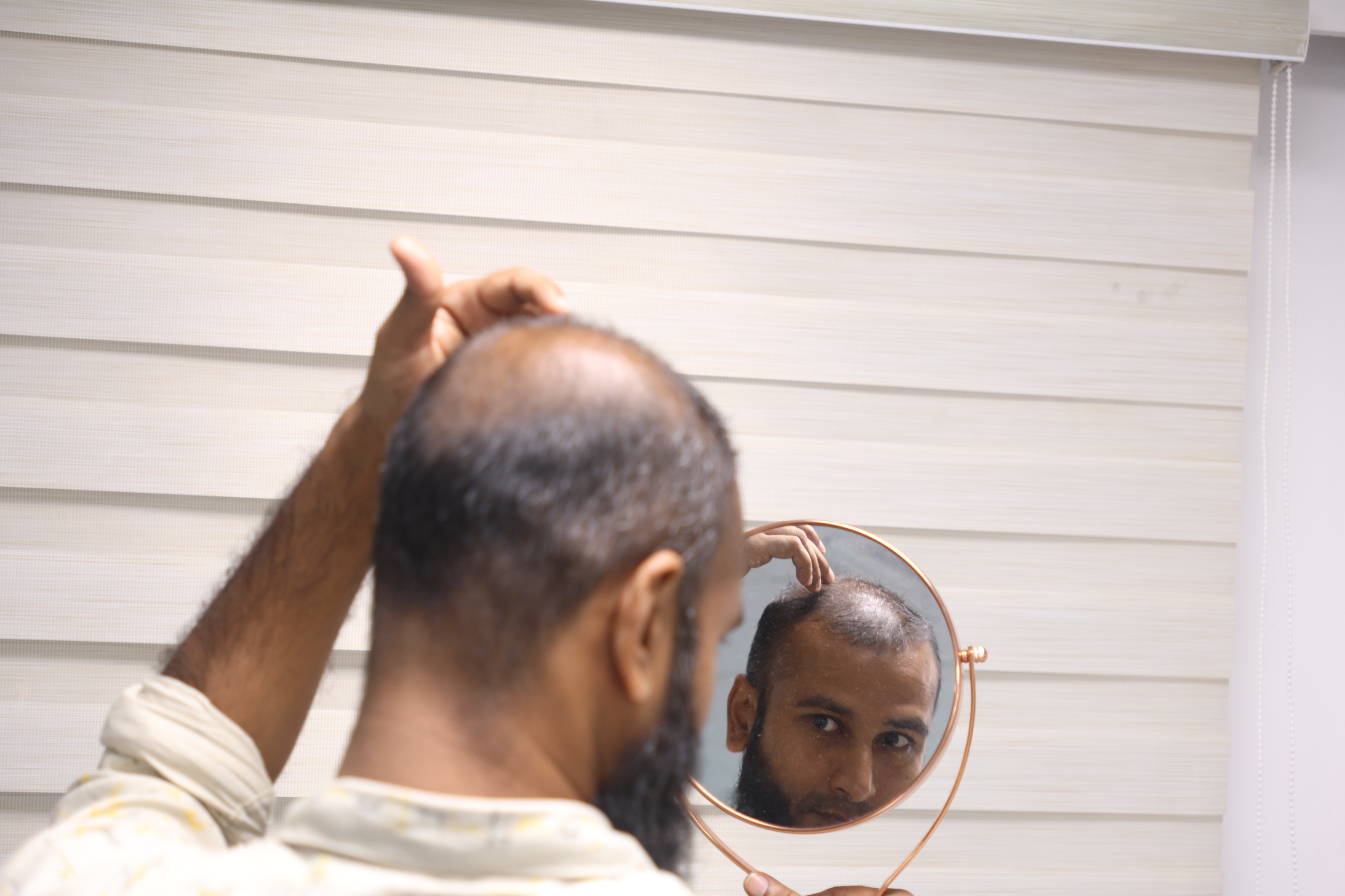 Hair Transplant