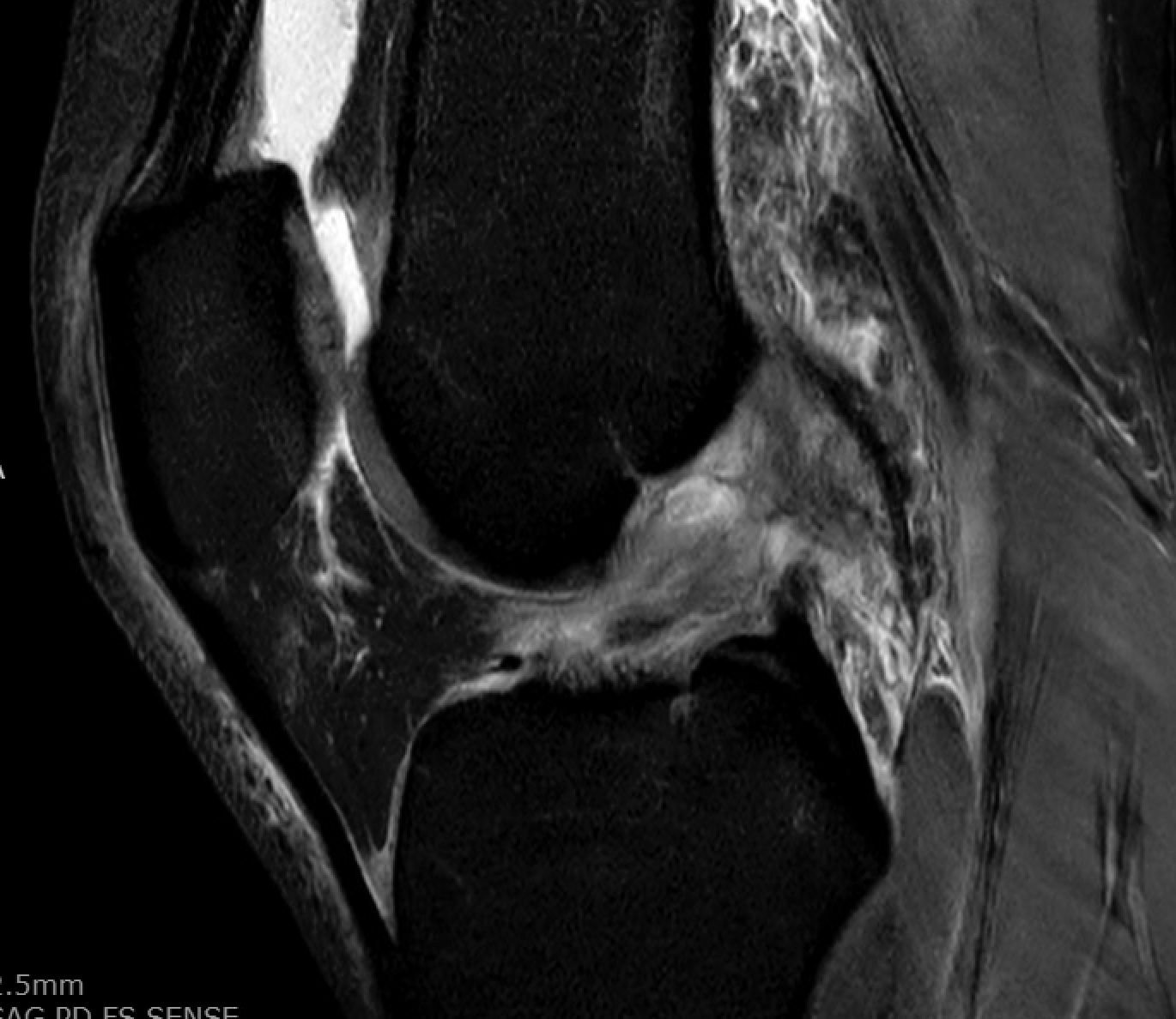 Mri Sagittal View Showing A Complete Acl Tear With Characteristic Edema And Fiber Discontinuity
