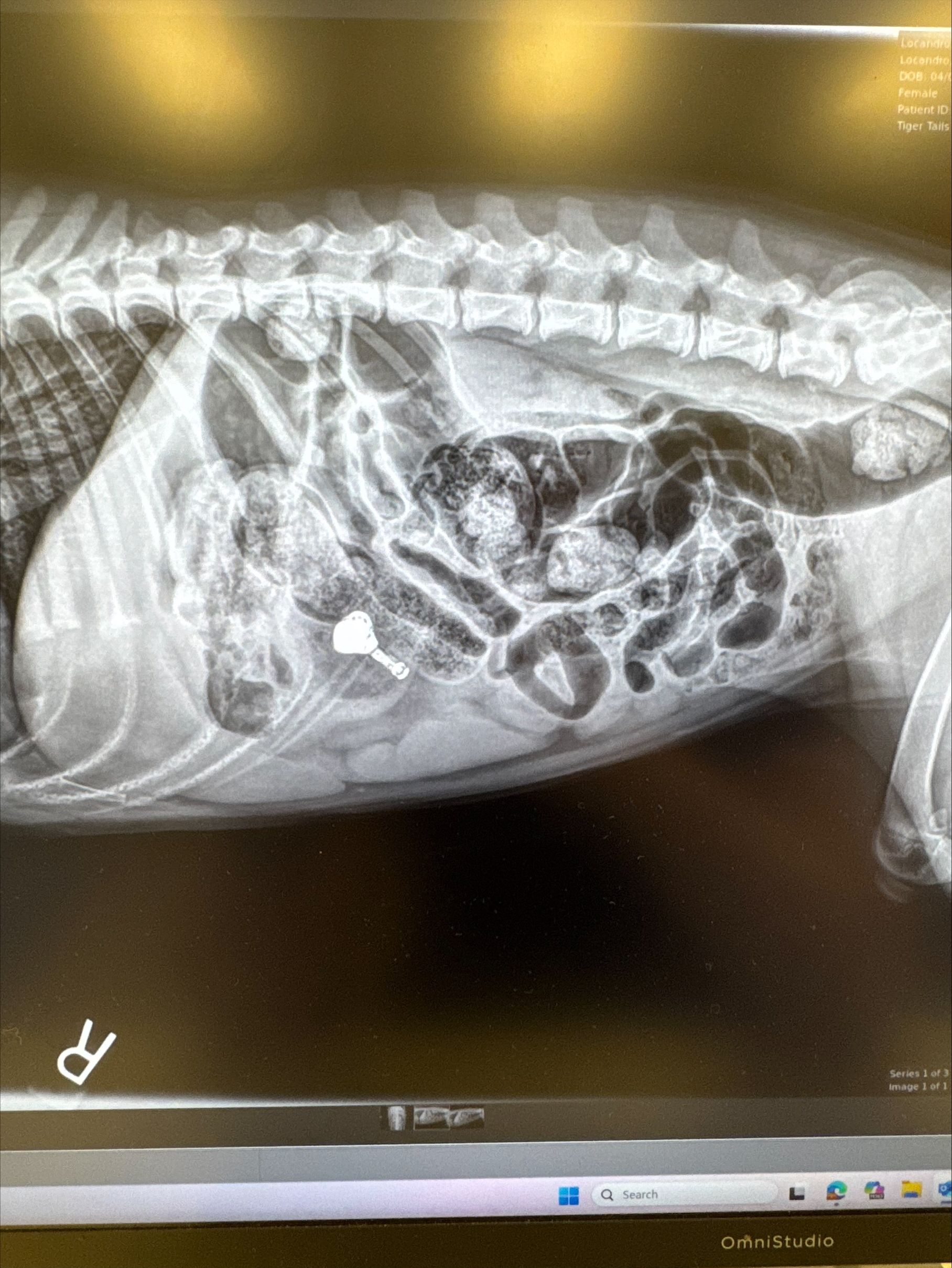 Case Report: The Curious Case of the Missing AirPod