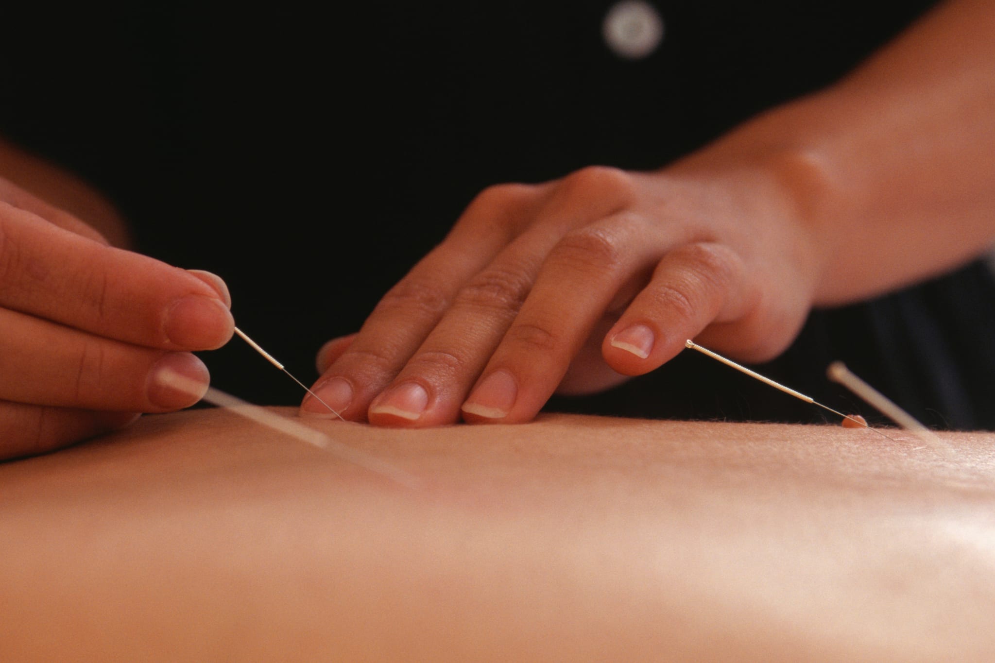 Acupuncture treatment at Therapy X clinic