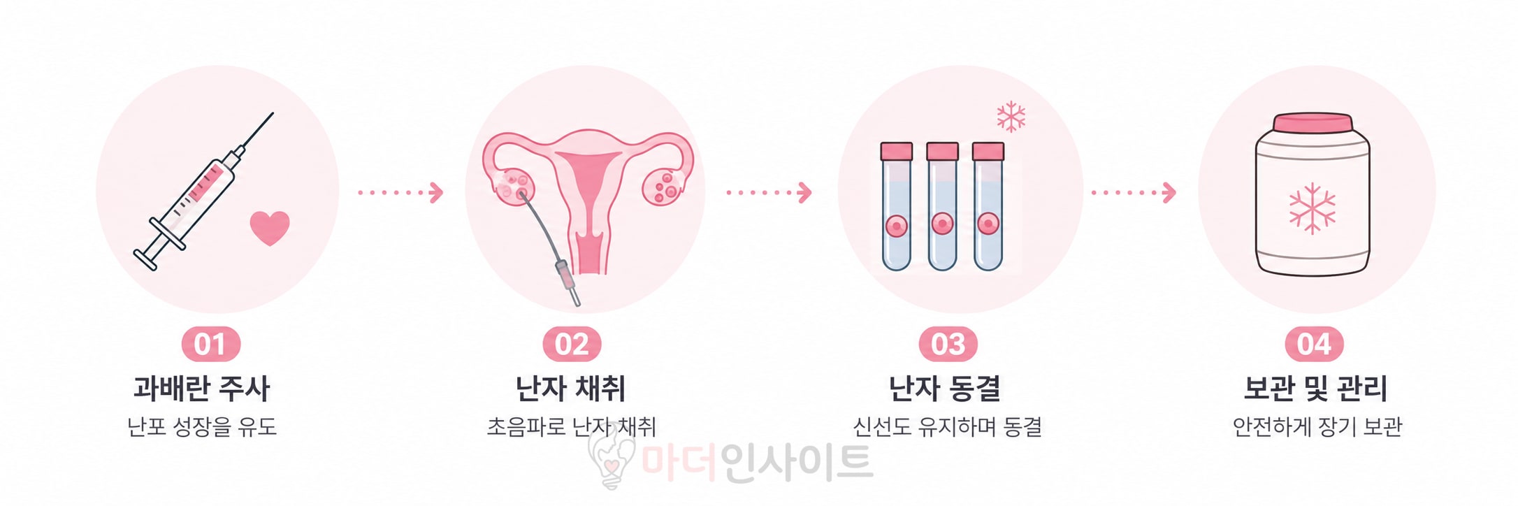 난자 채취