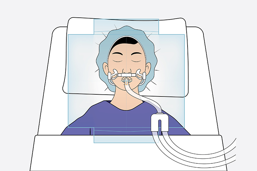 Illustration of Extubation Bib lying flat over patient's face with anesthesia tubing attached and going through bib's center.