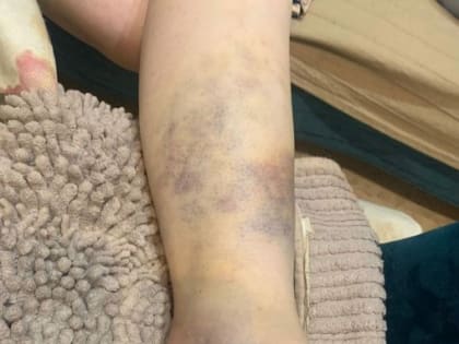 Орловский фельдшер заявила о нападении на неё пациентки и бездействии полиции