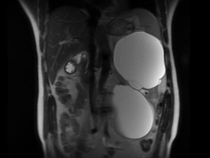 Хирурги Орловской областной клинической больницы удалили пациенту гигантские кисты на почке