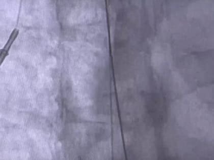 Сосудистые хирурги ООКБ провели орловчанке операцию по удалению отломившейся части порт-системы