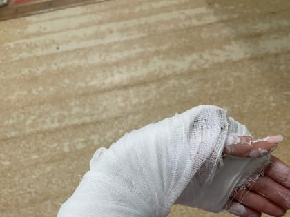 Более 150 человек обратились в Ливенскую больницу с переломами и травмами