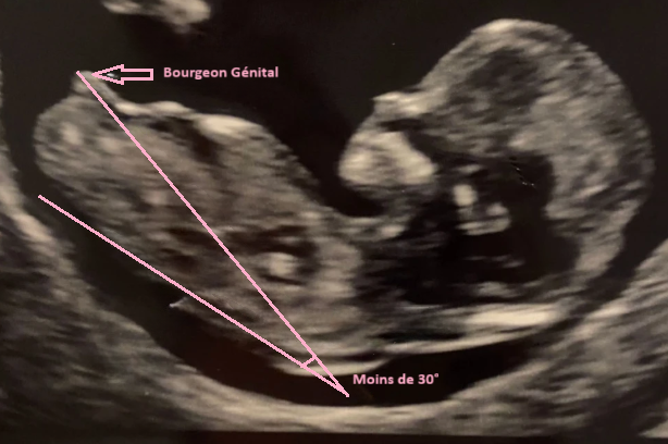 Échographie montrant un indice fille avec un bourgeon génital horizontal.