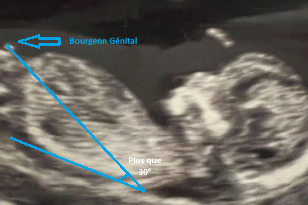 Échographie montrant un indice garçon avec un bourgeon génital ascendant.