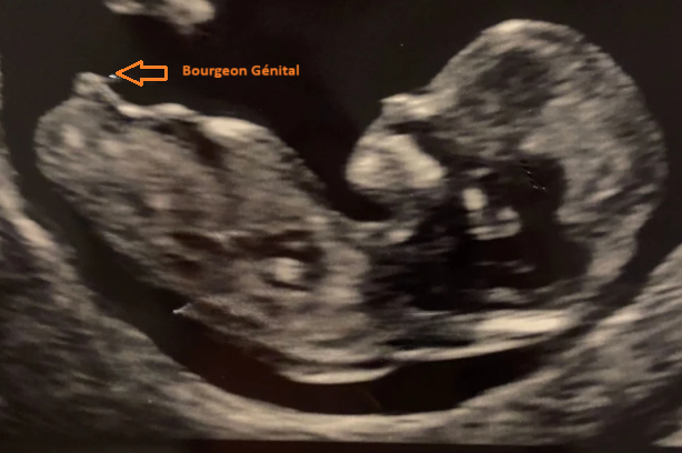 Schéma d’un fœtus très précoce avec une flèche pointant sur le tubercule génital indifférencié.