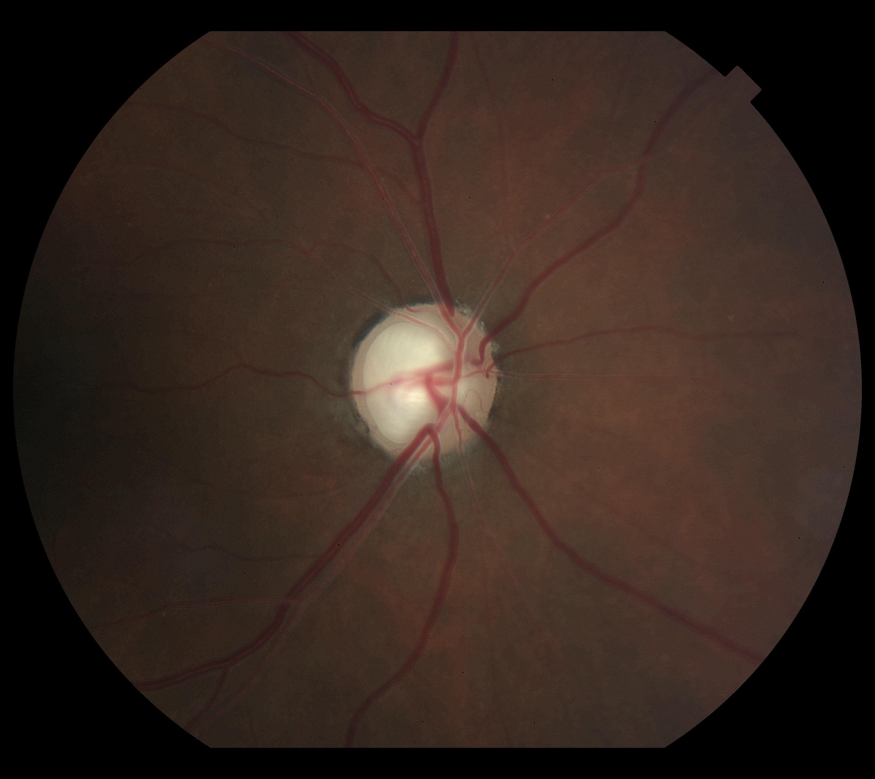 Glaucoma diagram showing optic nerve damage and changes in vision
