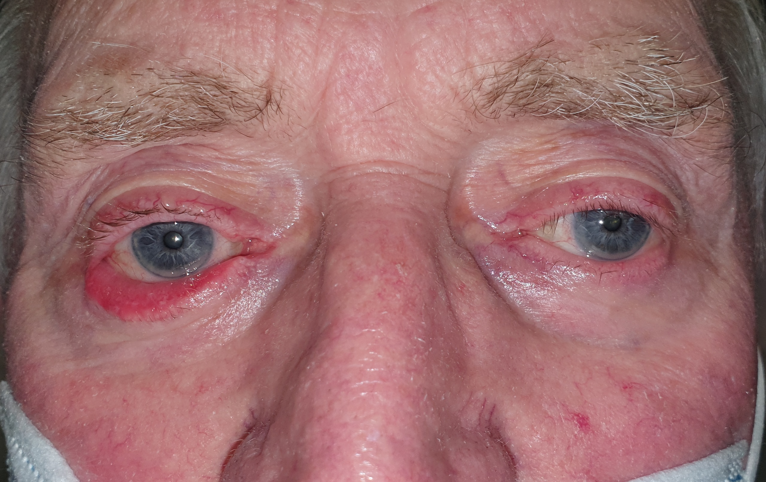 Ectropion and entropion diagram showing eyelid turning outward or inward