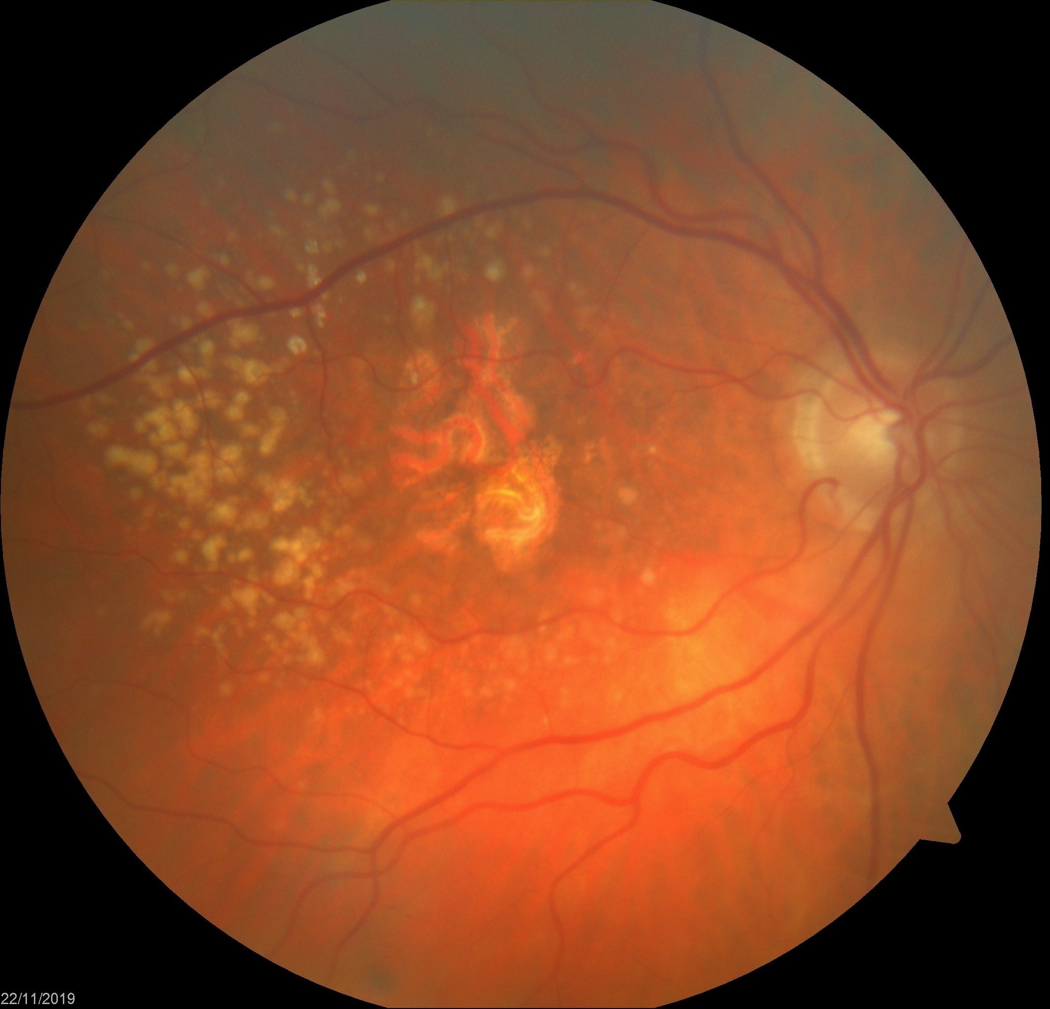 Macular degeneration diagram illustrating macula changes affecting central vision