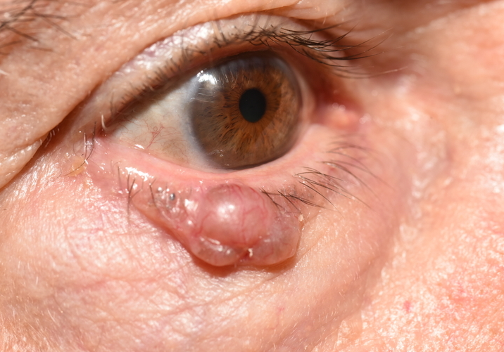 Diagram showing types of periocular skin cancers including basal cell carcinoma, squamous cell carcinoma, melanoma and other rarer types