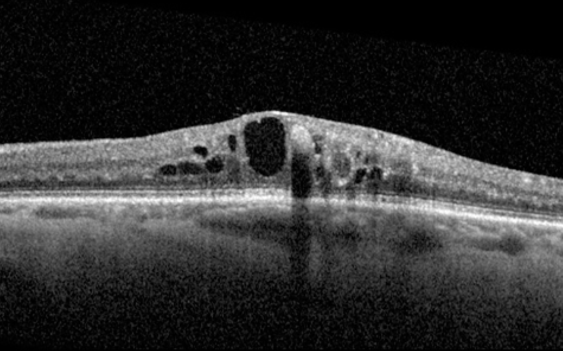 Diabetic macular oedema (DMO/DME) diagram showing fluid and swelling in the macula