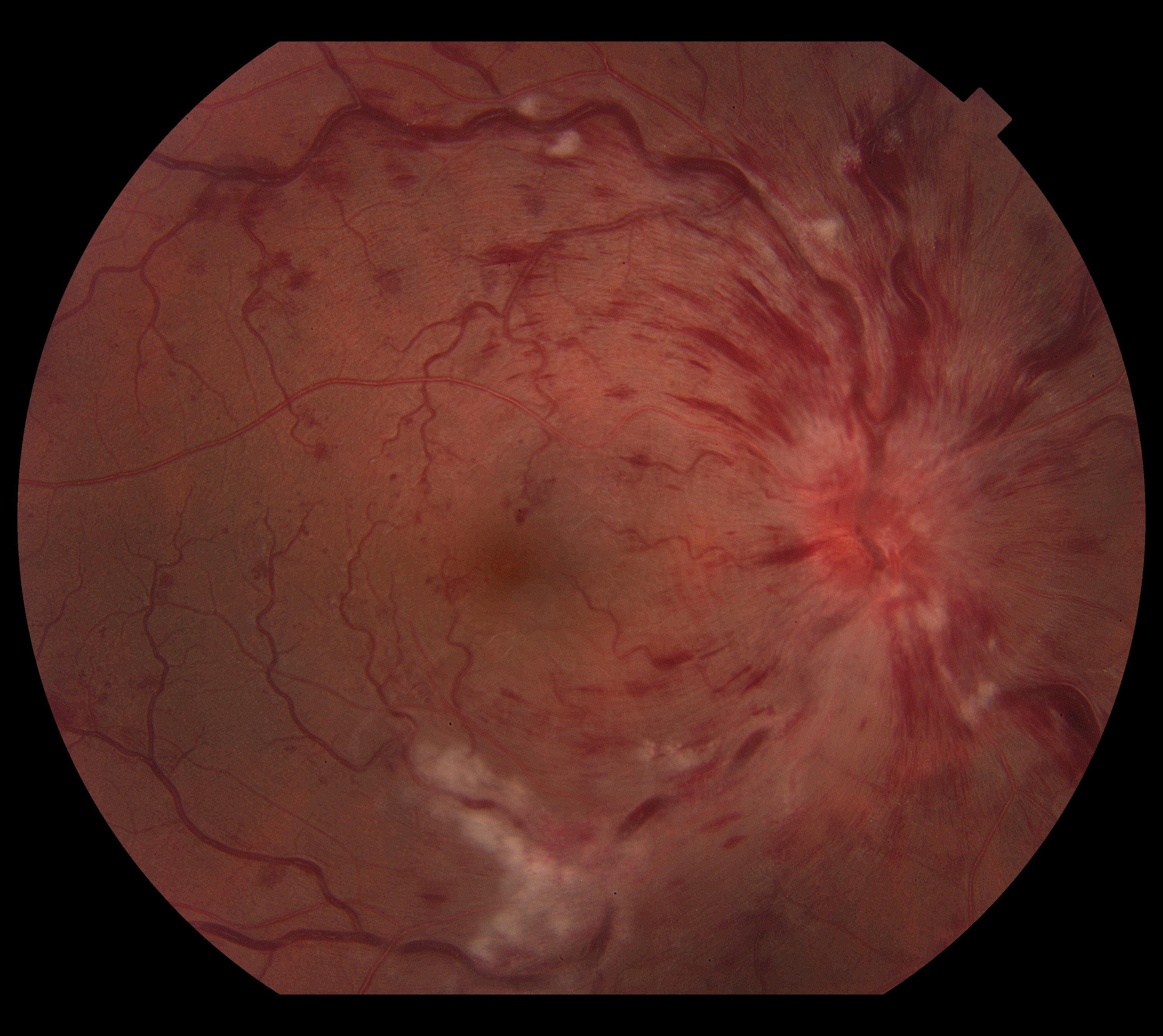 Retinal vein occlusion diagram showing blocked retinal vein and retinal haemorrhage