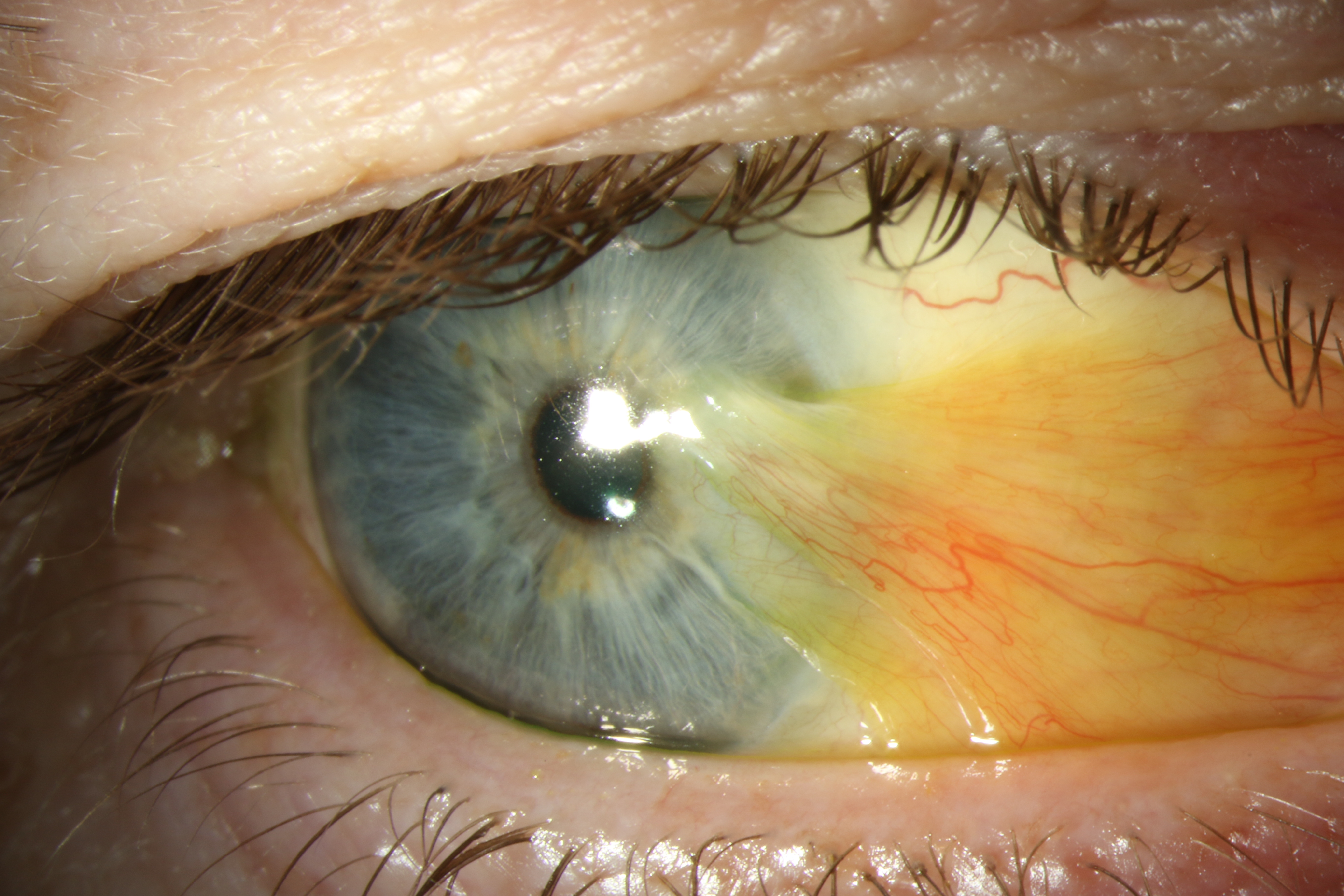 Pterygium diagram showing a fleshy growth extending from the white of the eye onto the cornea