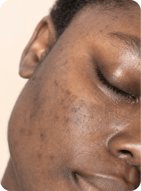 Dark spots & discoloration