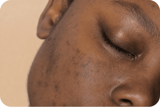 Dark spots