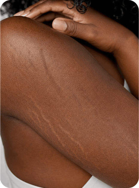 Scars and stretch marks