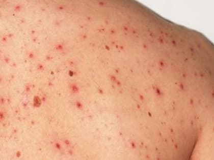 Пожизненная инвалидность, слепота и глухота: чем опасна корь и есть ли вирус в Великих Луках