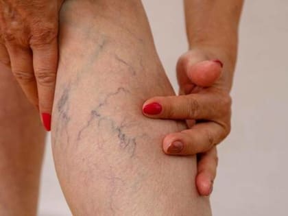 Попрощайтесь с варикозом навсегда: натуральная мазь для лечения вен и улучшения кровотока