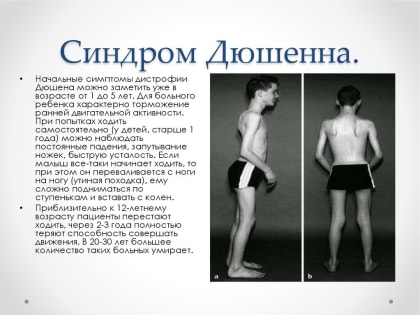 Диагностика мышечной дистрофии Дюшенна