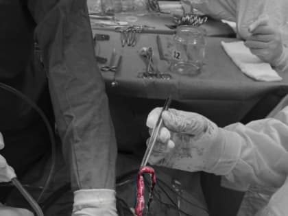 Кардиохирурги ЛОКБ удалили у пациента тромб длиной 20 сантиметров