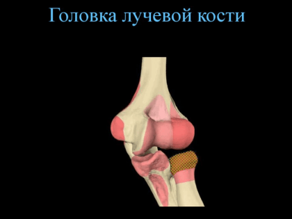 Свердловские хирурги впервые установили протез на головку лучевой кости