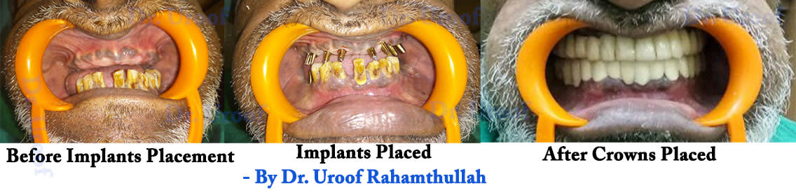 Implants supported Denture placed in upper missing teeth area