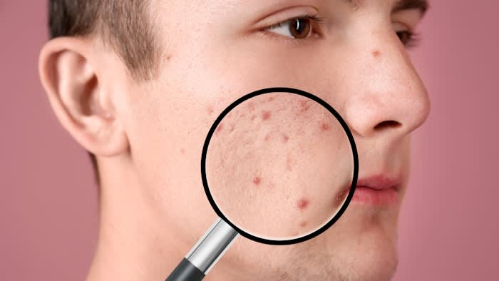 Skin Microbiome Health: Solving Persistent Skin Issues